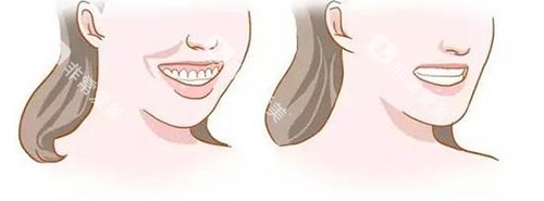 牙齿矫正脸型变化对比漫画图