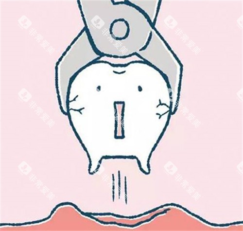 牙齿拔除过程展示