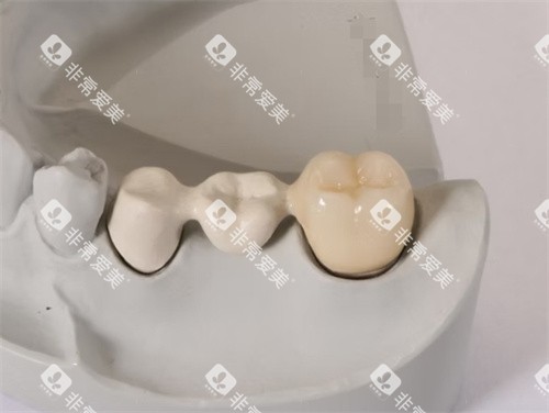 peek支架定制假牙