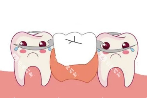 活动假牙安装卡通图