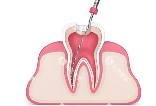 根管治疗卡通展示