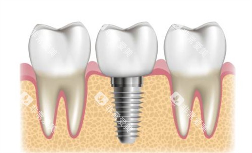 种植牙周围健康牙