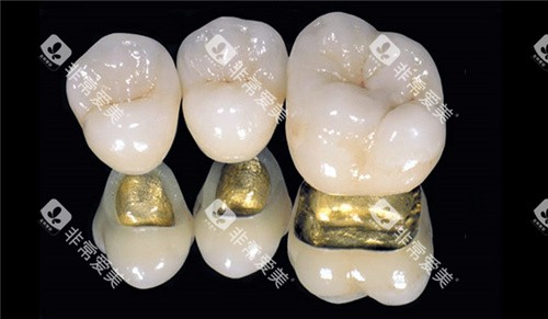 烤瓷牙三颗素材图片