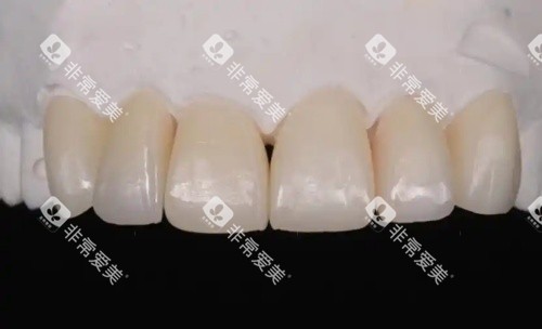 爱迪特全瓷牙示意图