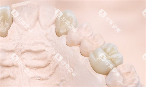 则武全瓷牙模型展示