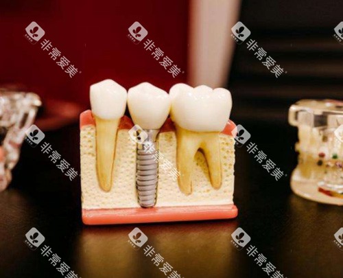 种植牙模具图 种植牙模具图