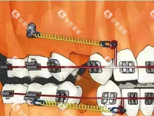 拔牙矫正骨钉种植钉