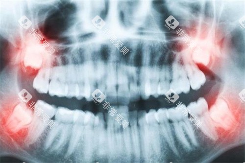 牙齿拍片图