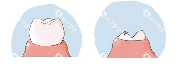 正常牙齿和坏牙对比