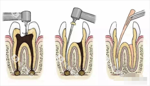 根管治疗过程展示图
