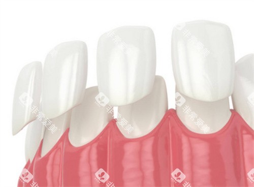 牙齿贴面动画展示图