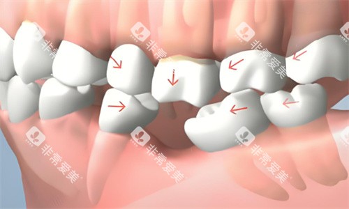 缺牙动画展示 缺牙动画展示