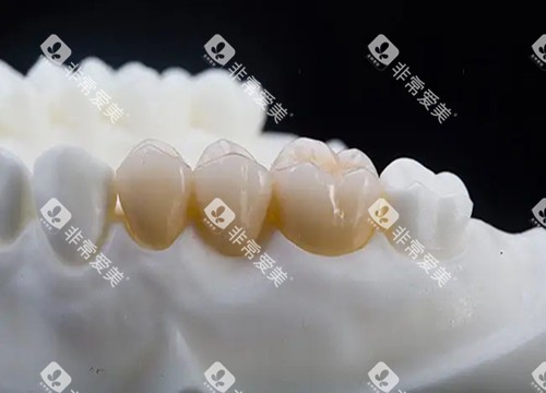 全瓷固定义齿实物示意图