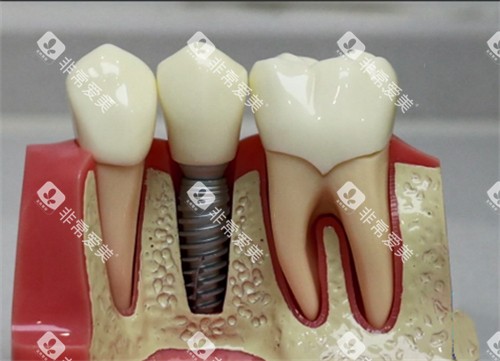 种植牙模型实物展示图 种植牙模型实物展示图