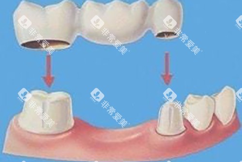 固定桥示意图 固定桥示意图
