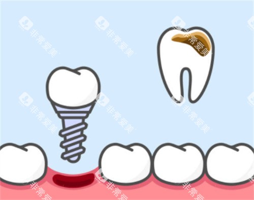 牙齿坏了换种植牙 牙齿坏了换种植牙