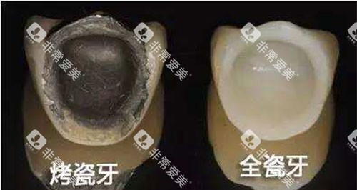 烤瓷牙和全瓷牙展示图