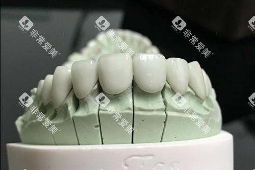 全瓷牙模型展示图