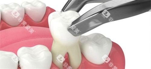 拔掉生长歪斜的牙齿 拔掉生长歪斜的牙齿