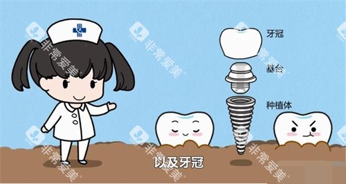 护士讲解种植牙结构漫画图