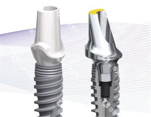 诺贝尔种植牙示意图