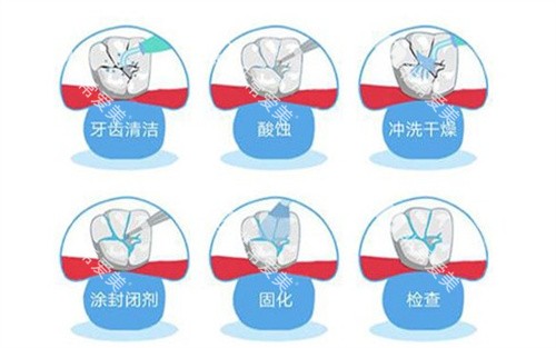 窝沟封闭的过程