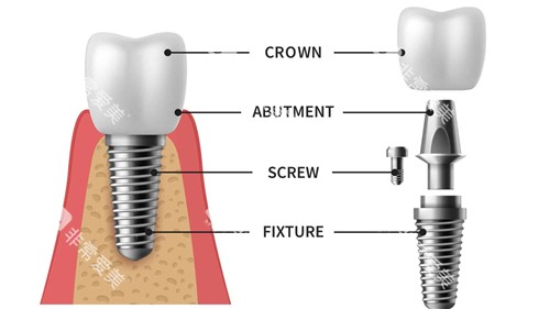 种植牙组成部分动画展示 种植牙组成部分动画展示