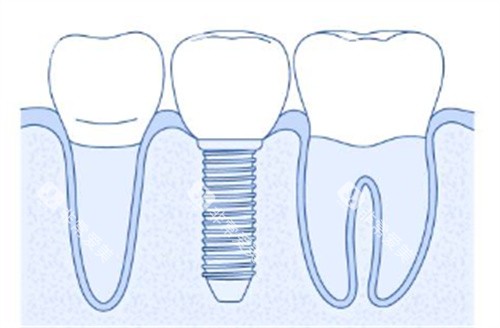 简单种植牙背景图 简单种植牙背景图