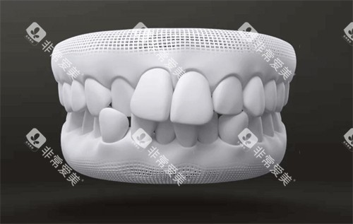 牙齿畸形图示 牙齿畸形图示