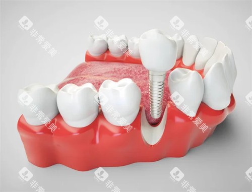 单颗种植牙展示