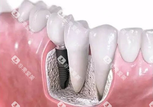 种植牙模具卡通图 种植牙模具卡通图