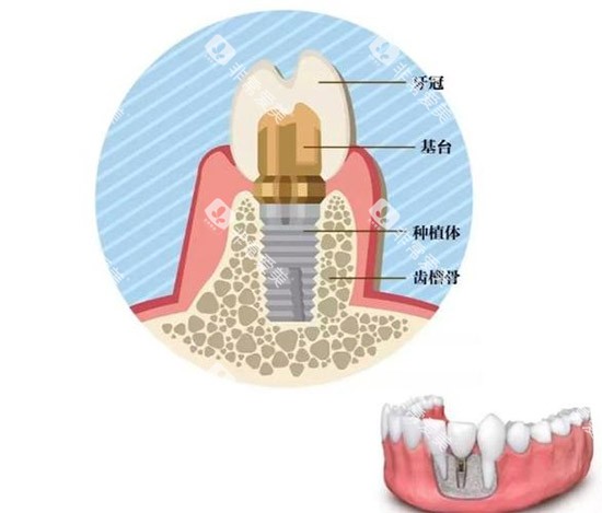 种植牙种类结构图 种植牙种类结构图