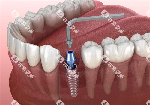 种植牙操作动画图片