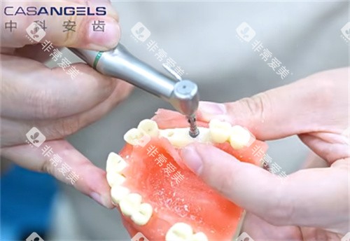 中科安齿种植牙钻孔