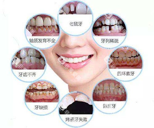 牙齿贴面情况示意图
