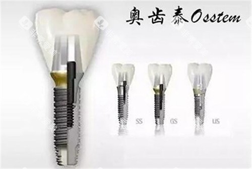 奥齿泰种植牙三个系列