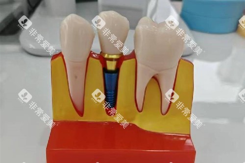 种植牙模型实拍