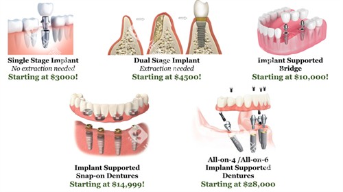 种植牙手术过程图 种植牙手术过程图