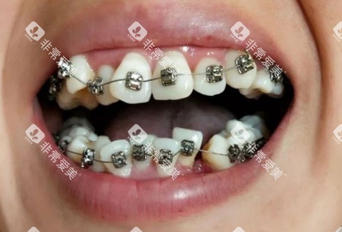金属牙齿矫正过程图