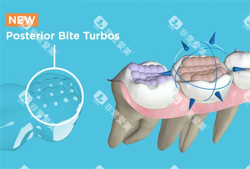 Spark精靓隐形矫正器后牙涡轮