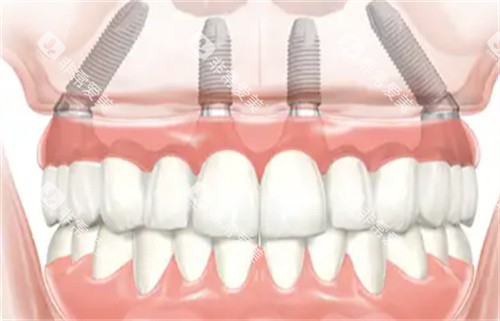 种植牙透视图