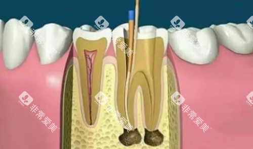 根管治疗动画演示