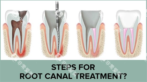根管治疗手术过程