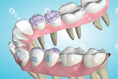 Spark精靓隐形矫正器方案设计时可以看到牙根