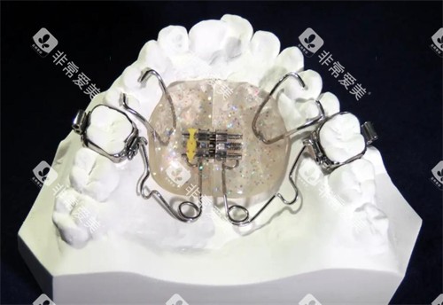 钟摆式矫治器好不好