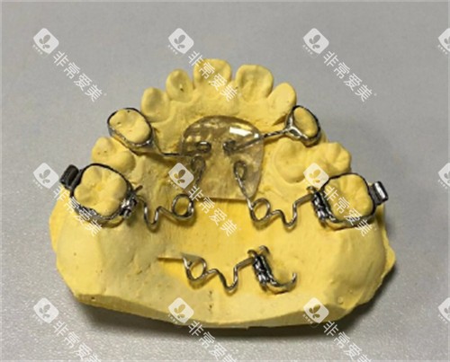 钟摆式矫治器多少钱