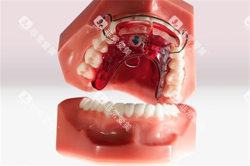 Balters Bionator矫治器佩戴方式