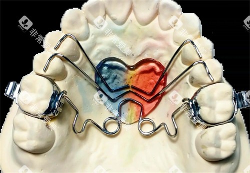 钟摆式矫治器外观