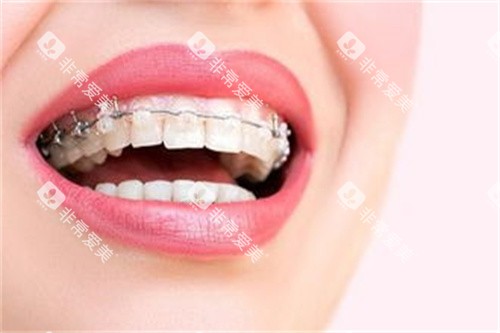 佩戴矫治器的样子 佩戴矫治器的样子