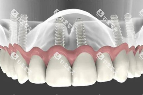 all-on-6种植模型图 all-on-6种植模型图
